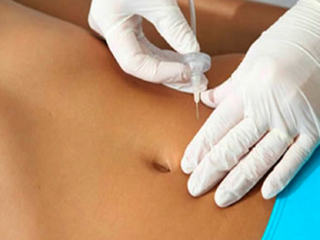 Carboxiterapia en Palma de Mallorca