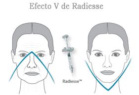 Recomendaciones pre y post tratamiento de Radiesse